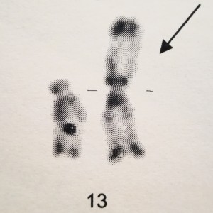imagine în care sunt desenați cromozomii responsabili de sindromul patau